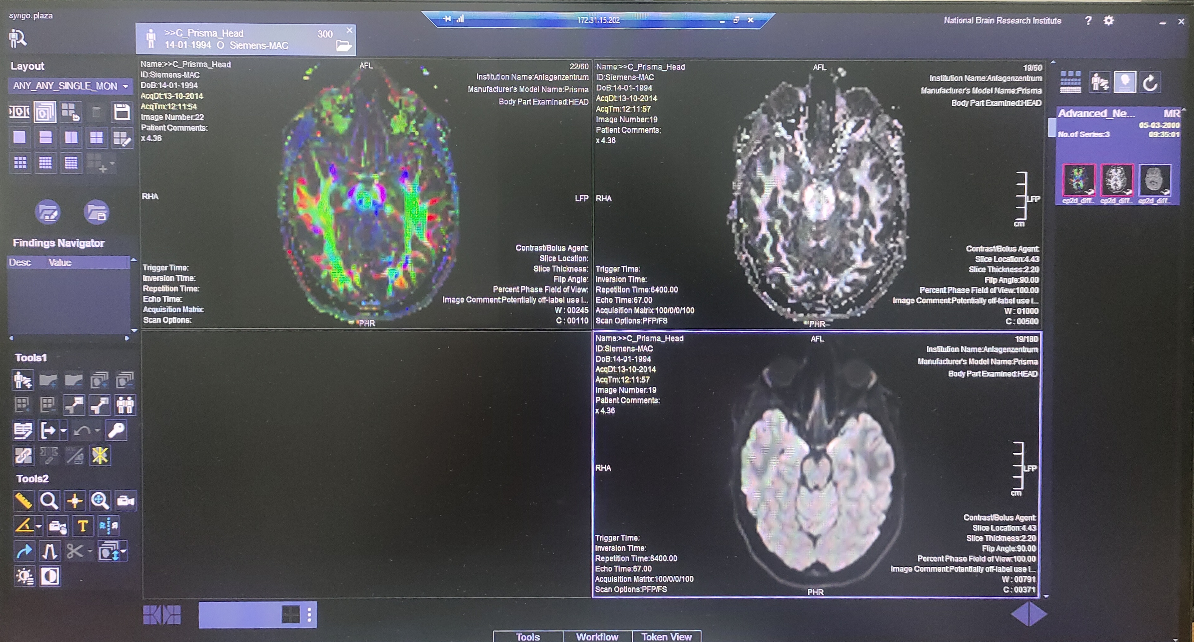 3D-brain imaging analysis using MRI